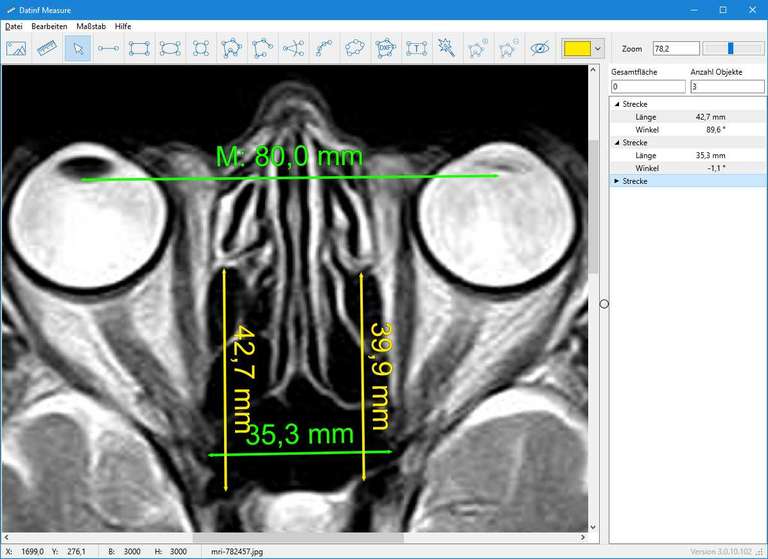 Screenshot Datinf Measure mit einem MRI-Bild